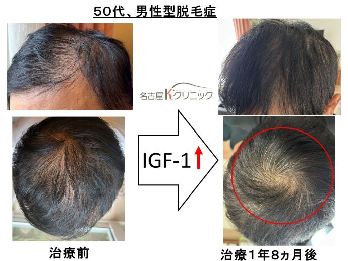 円形脱毛症　病院
